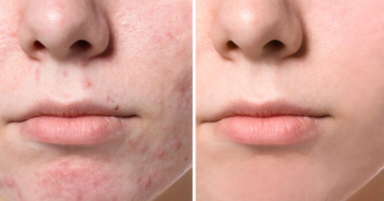 Drmtlgy Cystic Acne Treatment Is a Miracle for So Many Shoppers