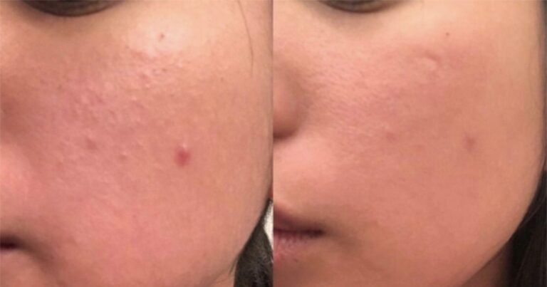 Sdara Derma Roller Is Producing Crazy Before and After Photos